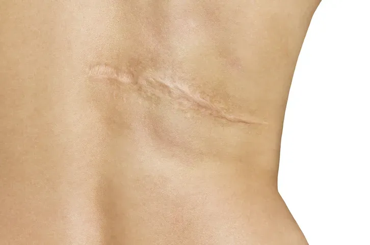 What Are the Best Options for Scar Removal?