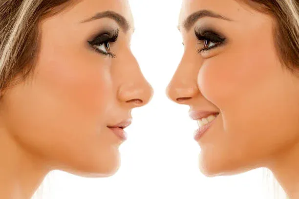 Surgical vs. Non Surgical Rhinoplasty