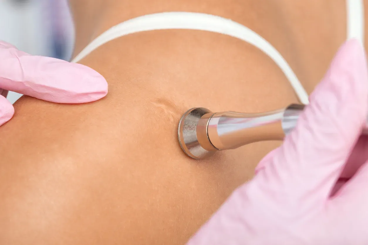 Laser Scar Removal: What you need to know