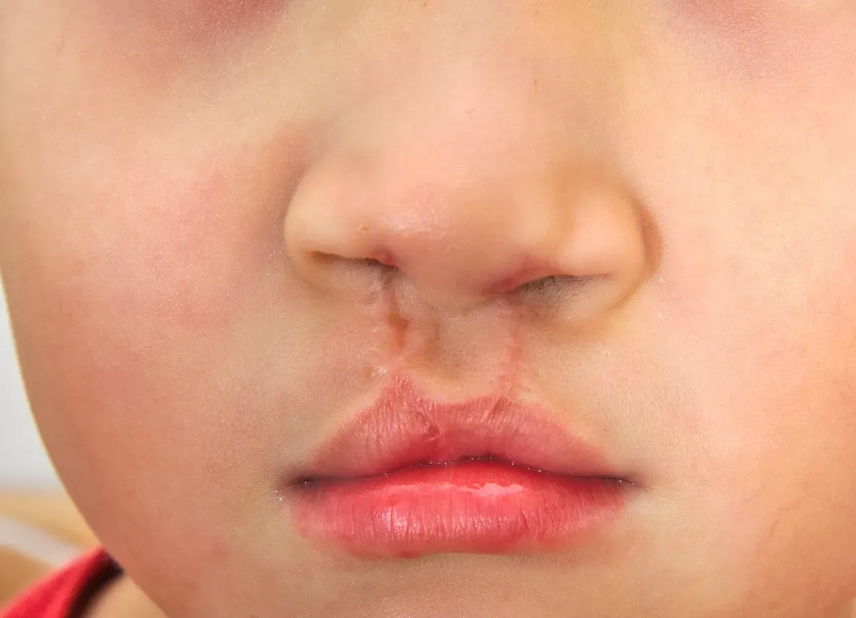 Everything you need to know about Cheiloplasty (cleft lip repair