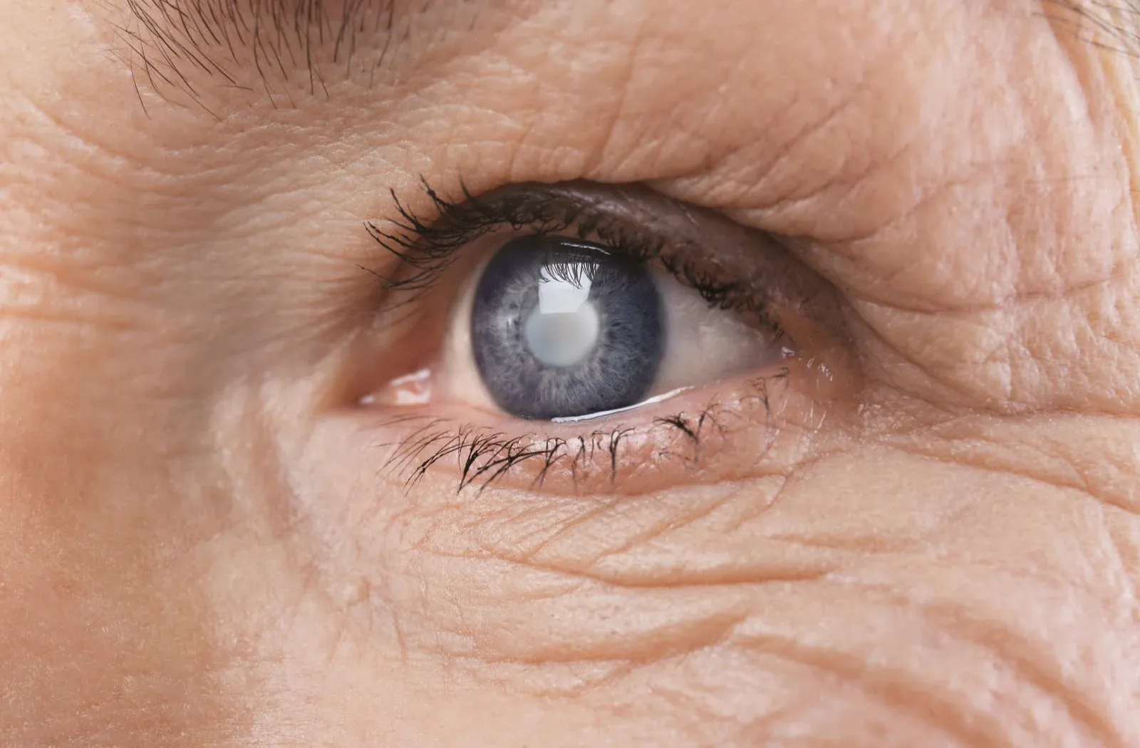 Glaucoma; Causes,  Diagnosis and Treatment