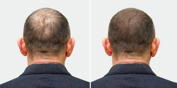 What are the side effects of Hair Transplant?