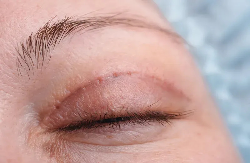 Role of Upper-Blepharoplasty in Facial Rejuvenation