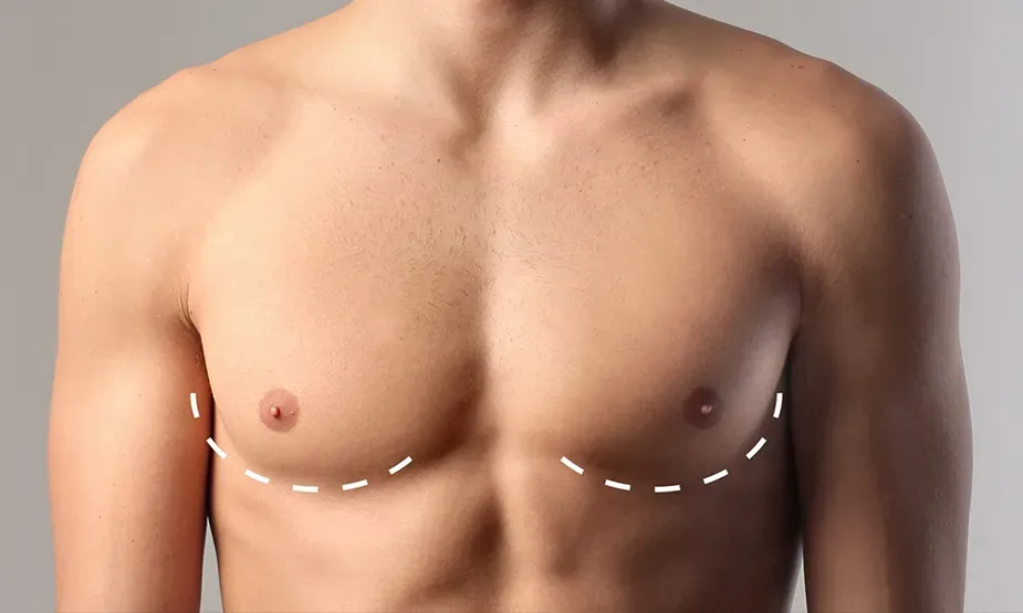 Why is Gynecomastia becoming more common?