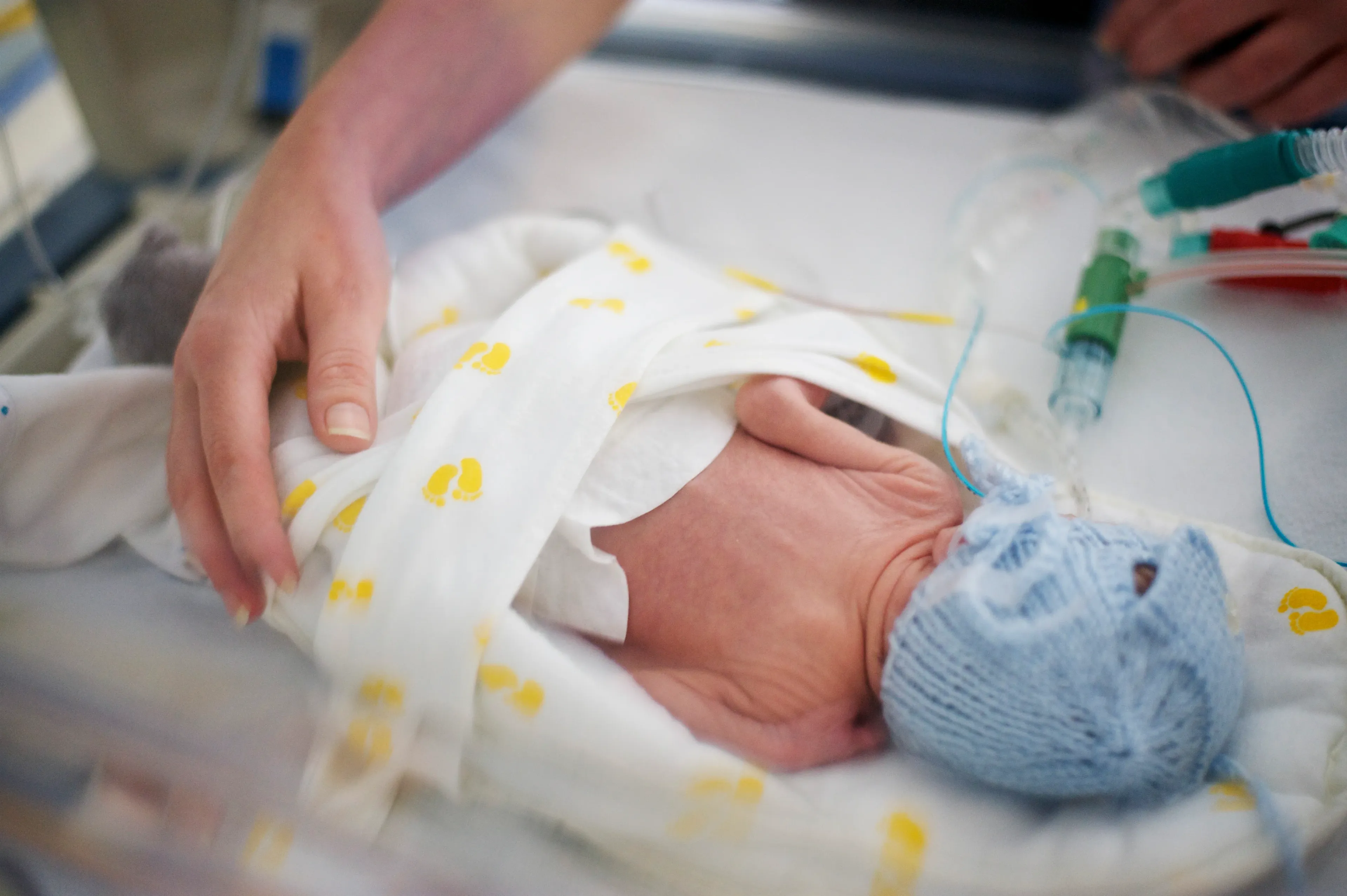 What is Patent Ductus Arteriosus (PDA)?