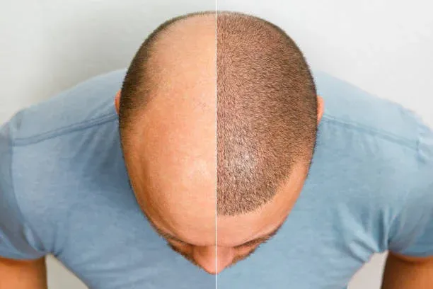 Are you a good candidate for Hair Transplant Surgery?