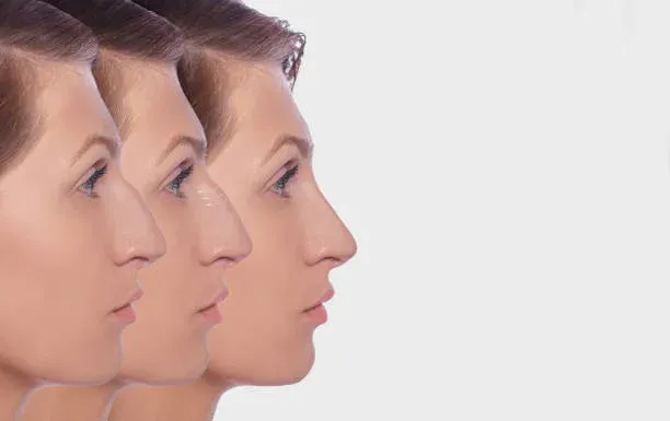 Surgical vs. Non Surgical Rhinoplasty