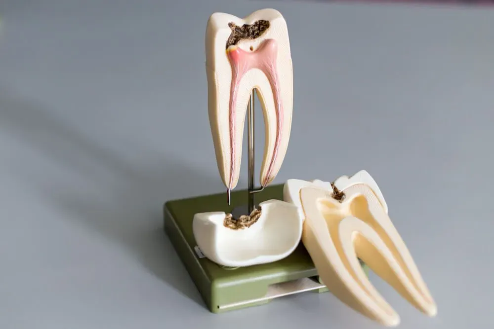 Everything you need to know about Endodontic Therapy