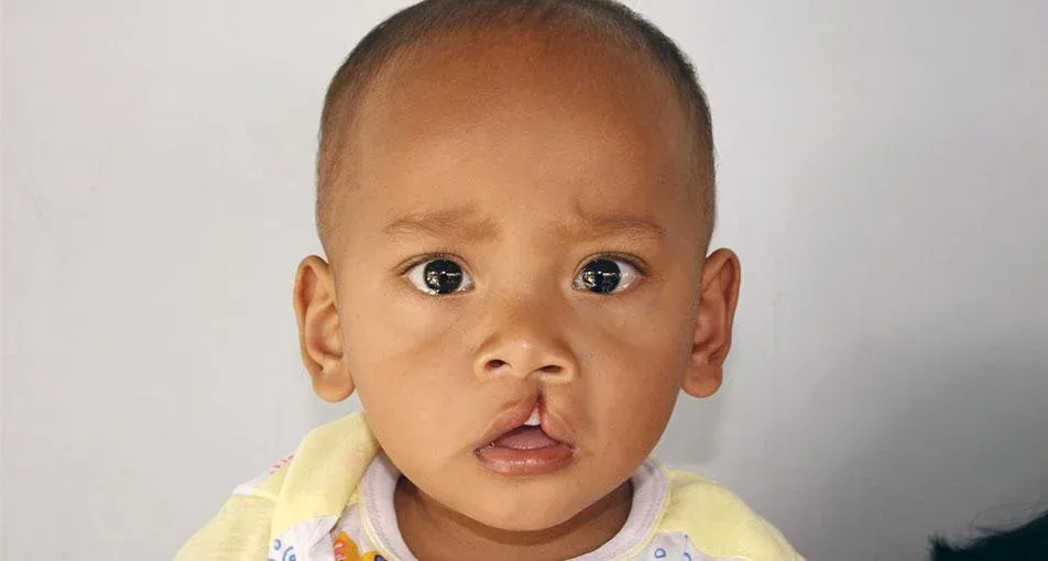 Everything you need to know about Cheiloplasty (cleft lip repair