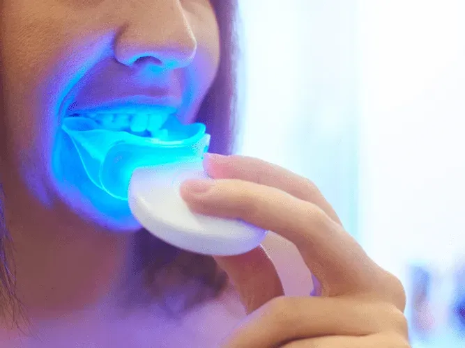 Everything you need to know before making your Teeth Whitening appointment