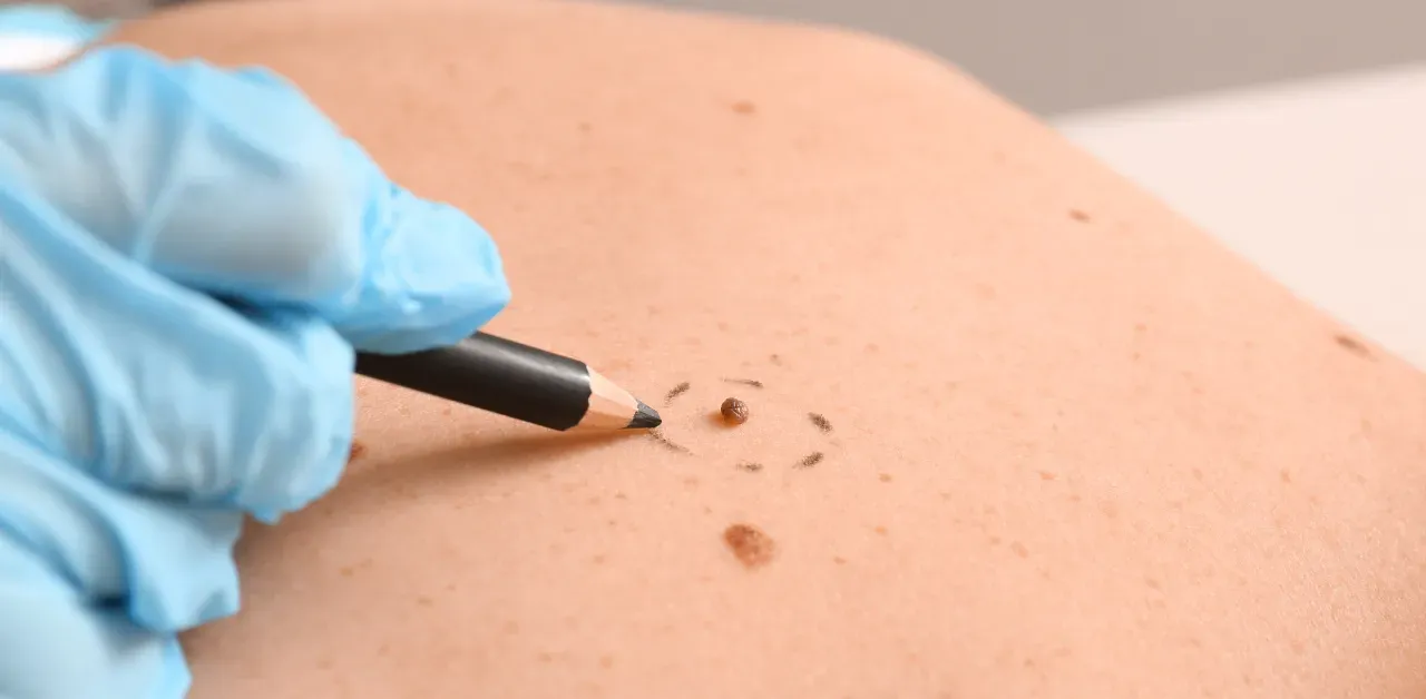 Skin Cancer: Stage & Treatments