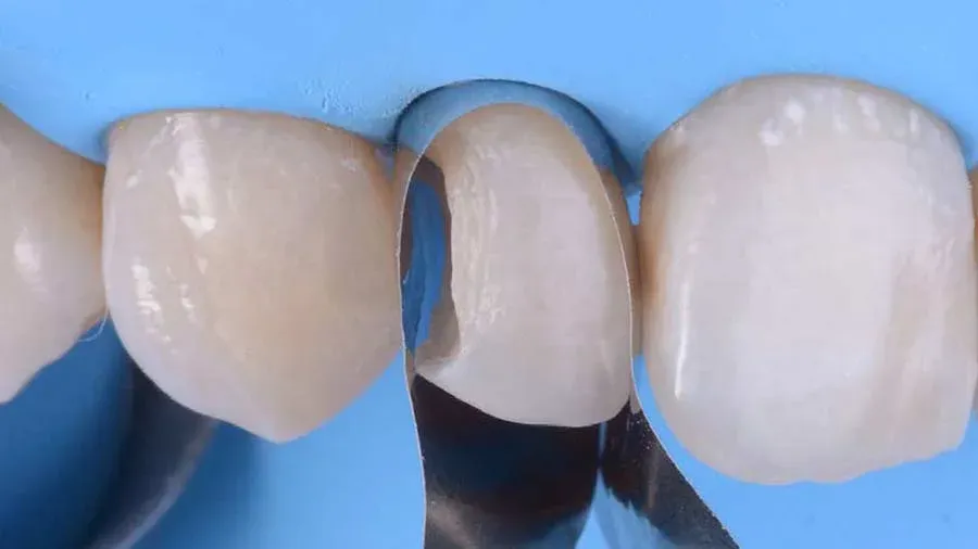 Composite veneers or Porcelain veneers; which one is right for me?