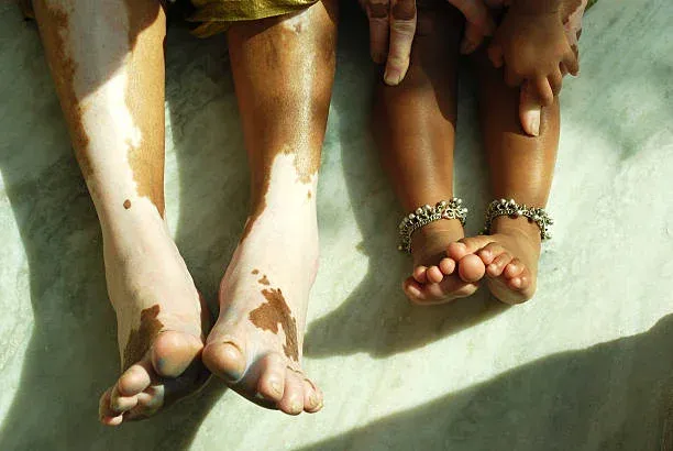 What is Vitiligo?