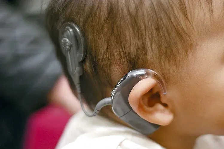 What does it mean to get a Cochlear Implant?