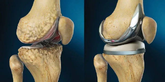 Types of Knee Replacement surgery