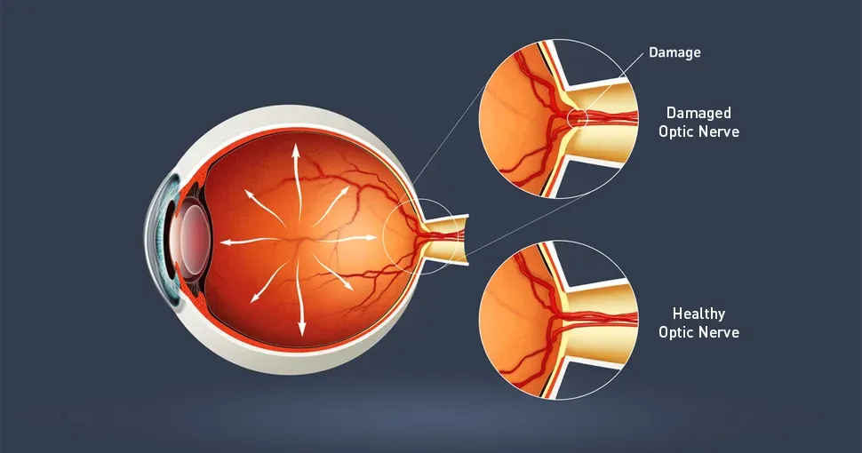 Glaucoma; Causes,  Diagnosis and Treatment