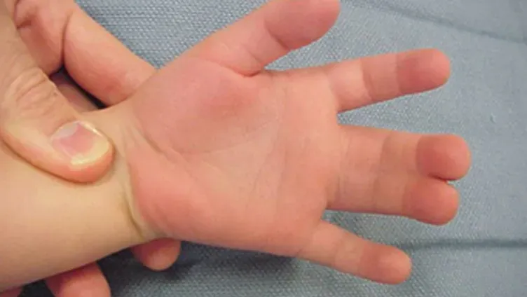 Why does Syndactyly occur & how is it treated?