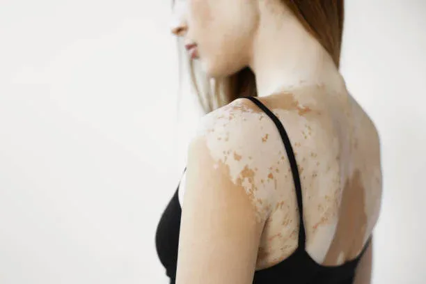 What is Vitiligo?