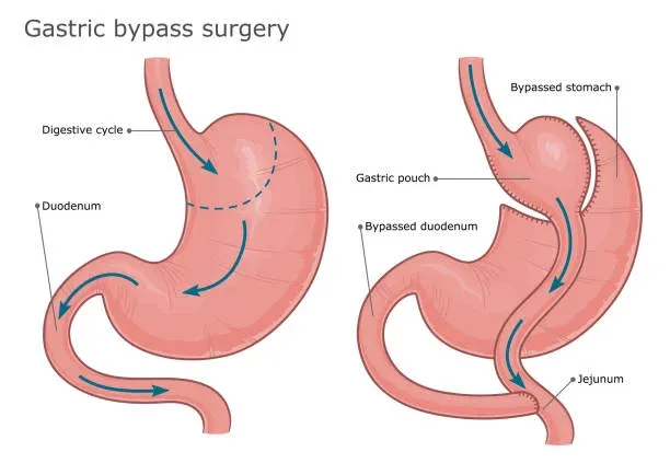 Benefits of gastric bypass operation