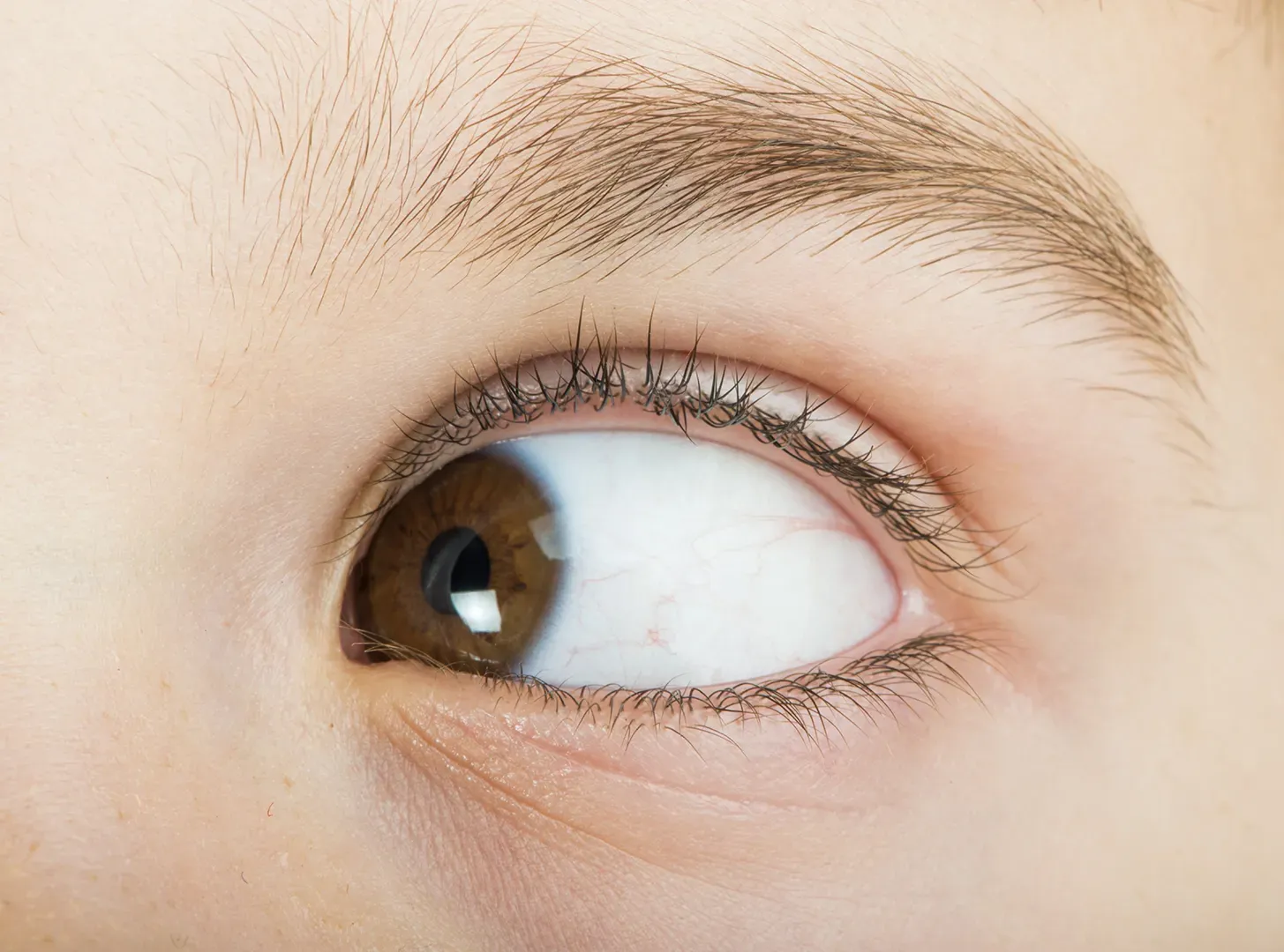 What causes Strabismus?