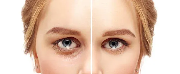 What is the difference between Canthoplasty & Blepharoplasty?