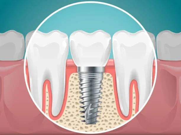 Dental Implant vs. Natural Teeth