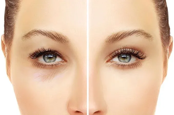 Role of Upper-Blepharoplasty in Facial Rejuvenation