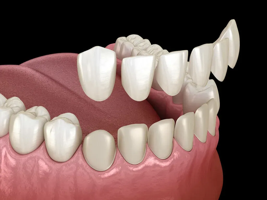 Composite veneers or Porcelain veneers; which one is right for me?