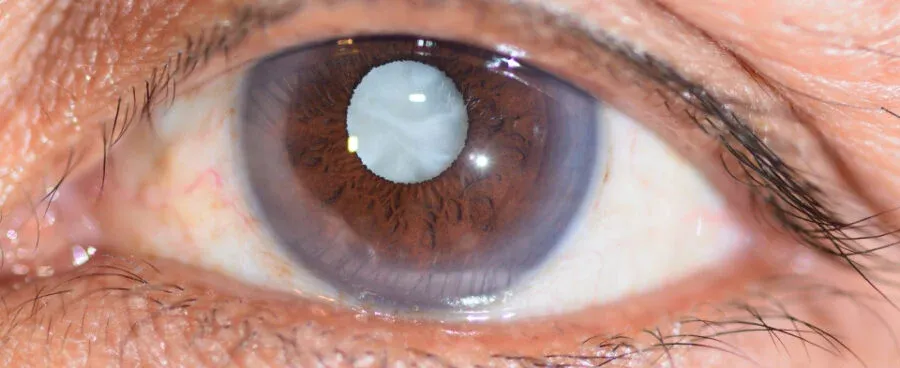 What are the signs of Cataract?