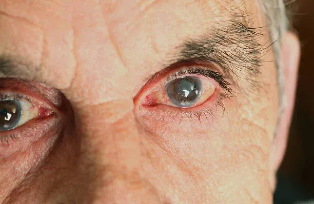 Why does Cataract occur?