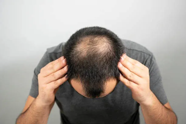 Hair Transplant