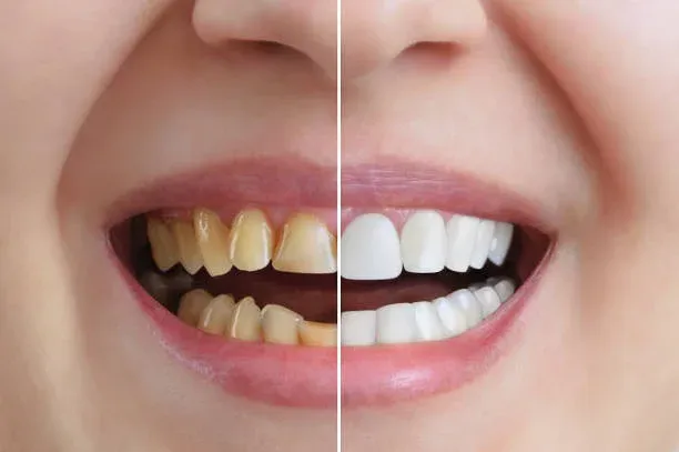 What is the difference between dental veneers & laminates?