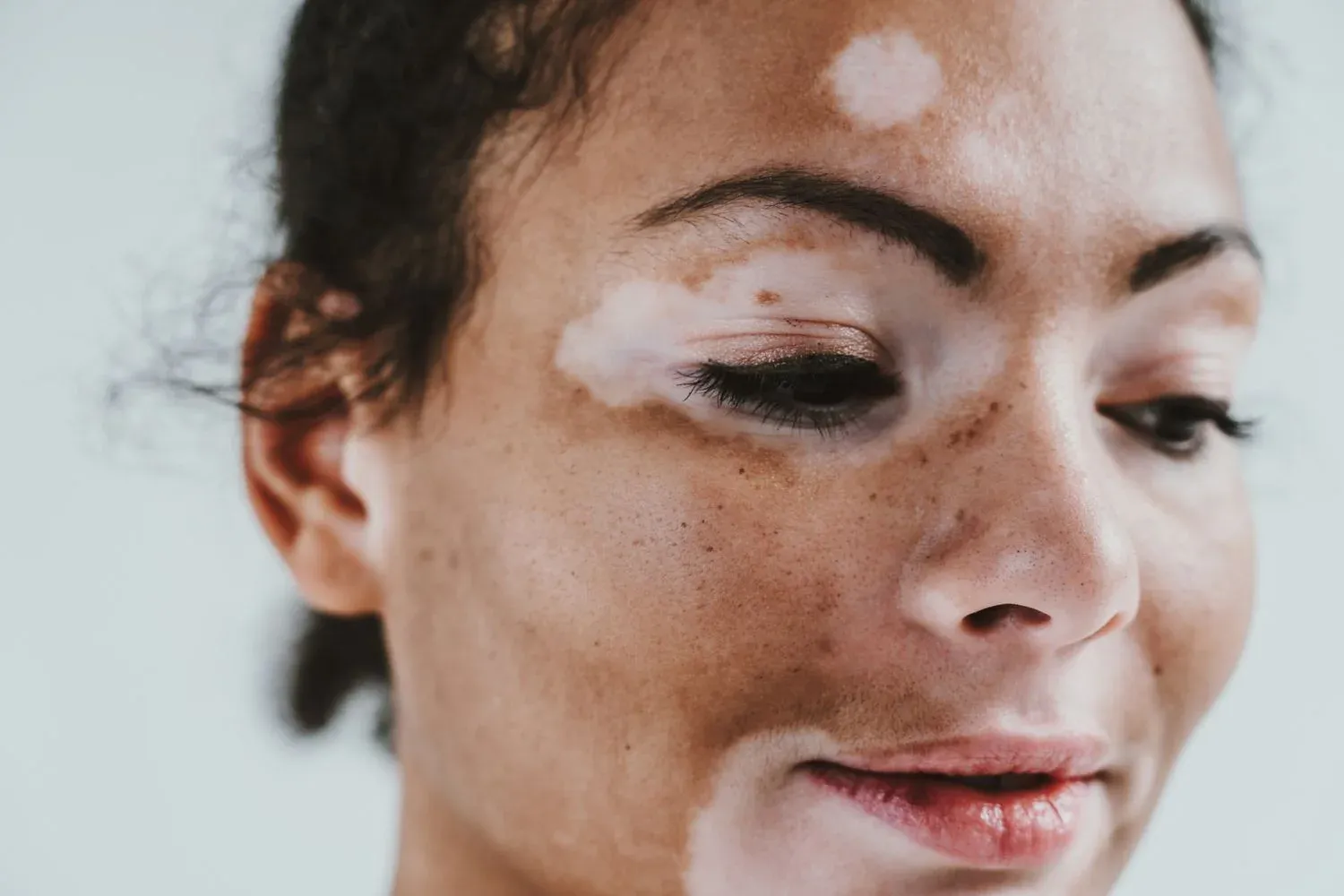 Vitiligo Symptoms, causes, and treatments