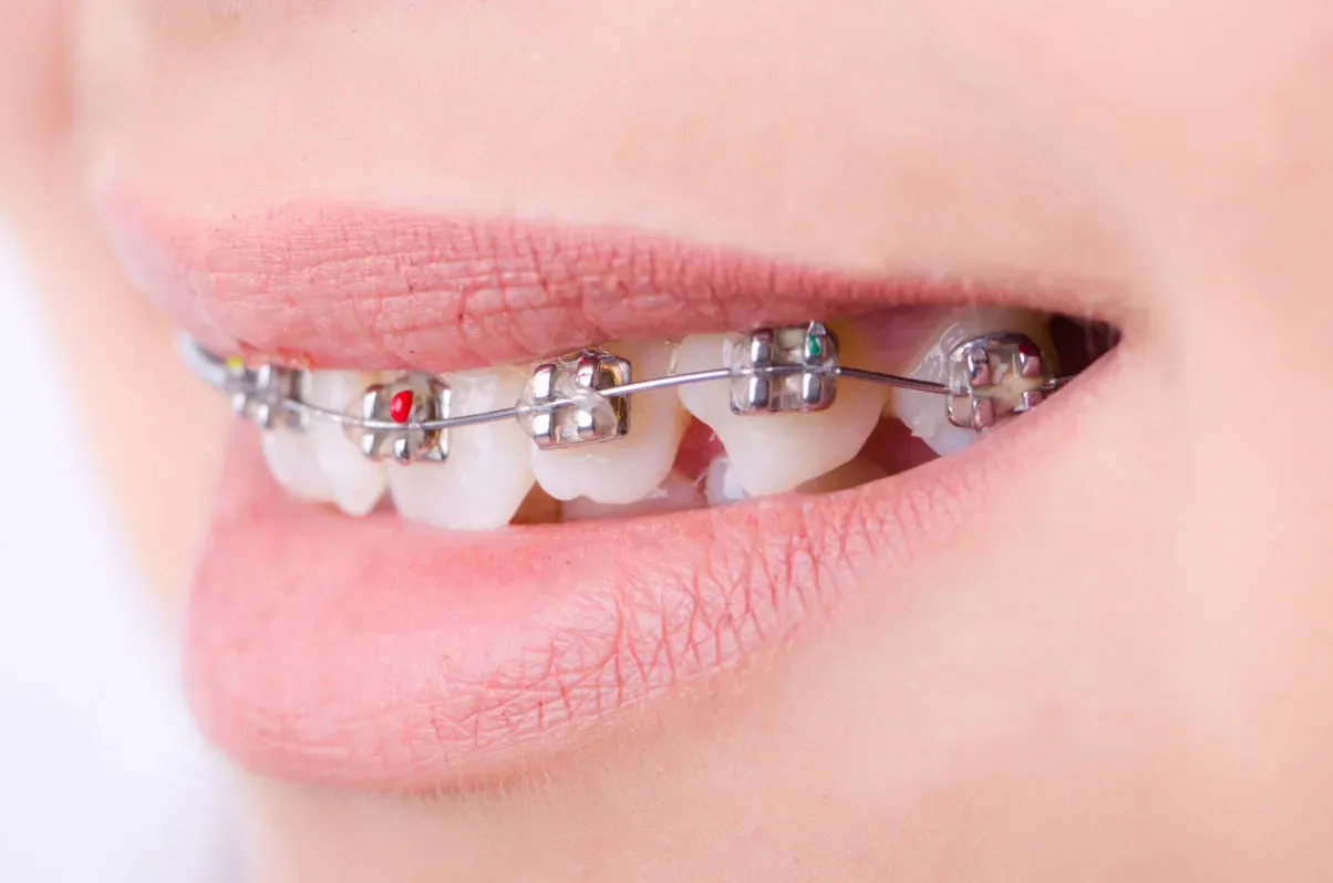 Orthodontic Treatment