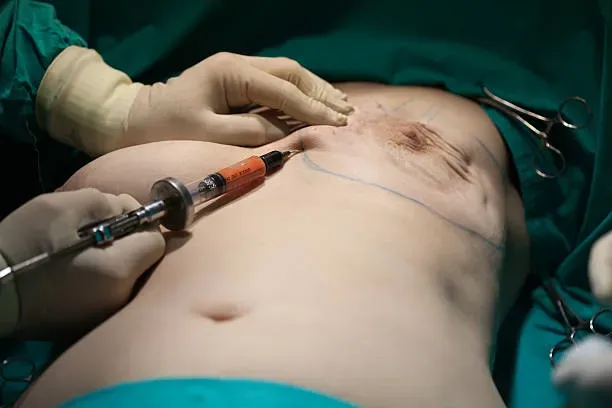 Mastectomy in Iran