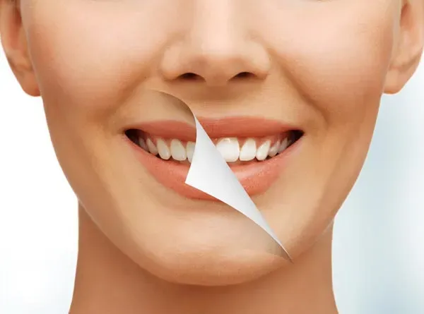 Teeth Whitening (Bleaching) in Iran