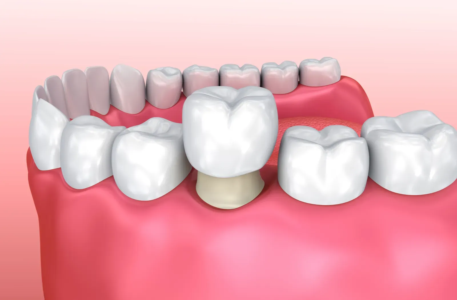 Dental Crown in Iran