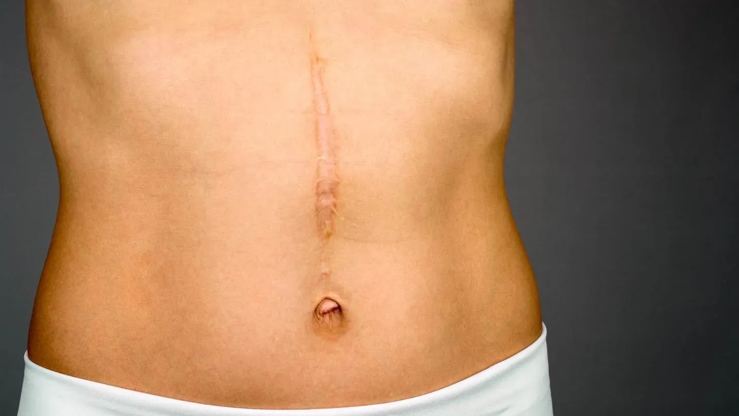 What Are the Best Options for Scar Removal?