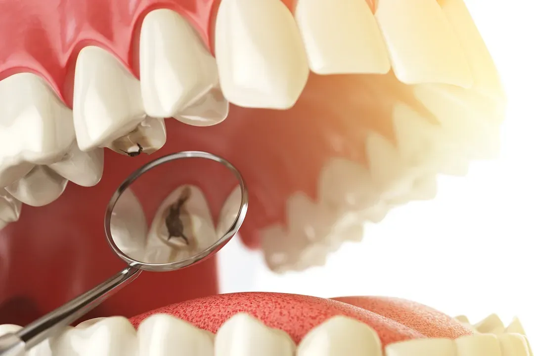 What materials are used in dental fillings?