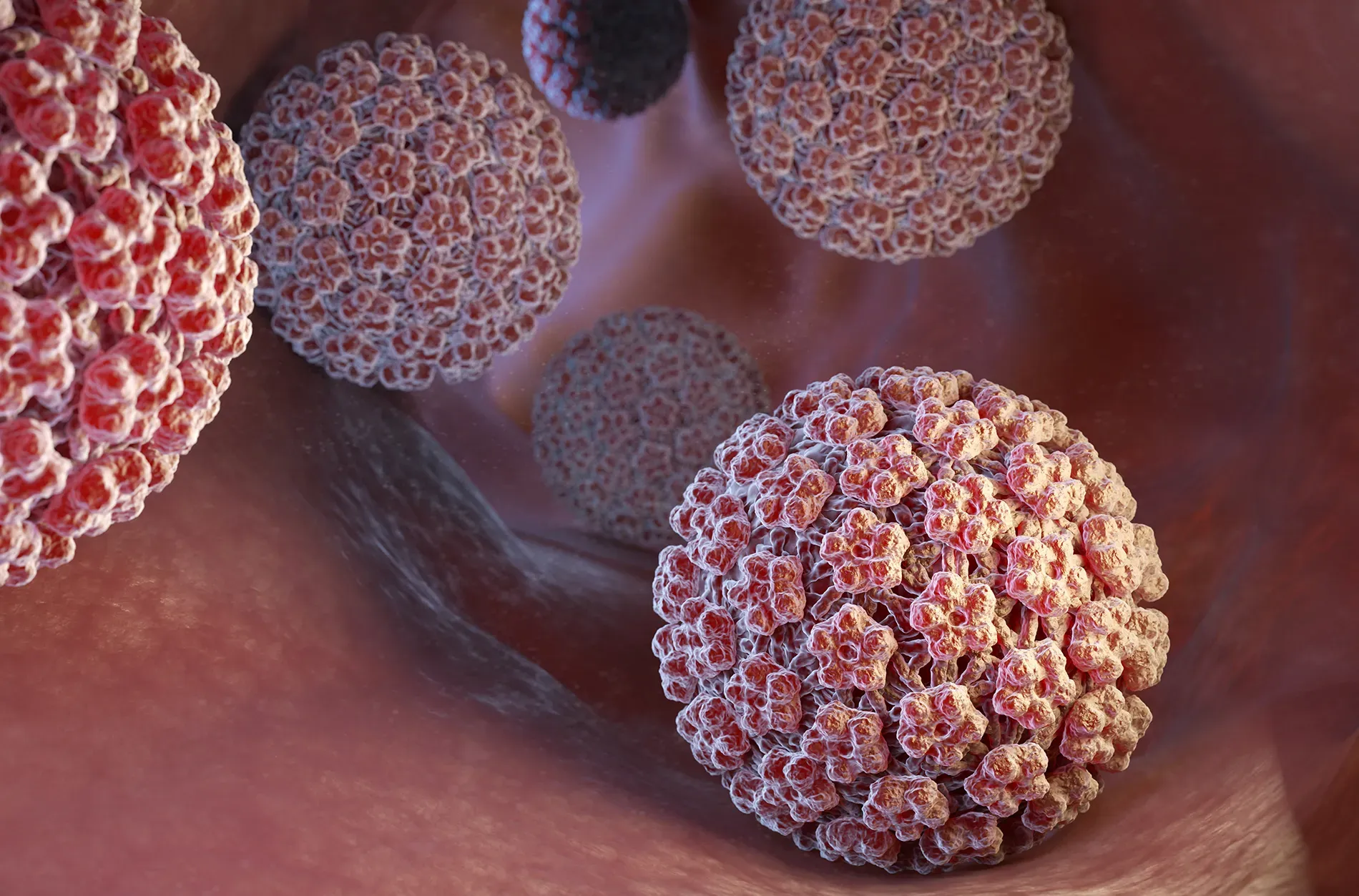 Human Papillomavirus (HPV) diagnosis in Iran