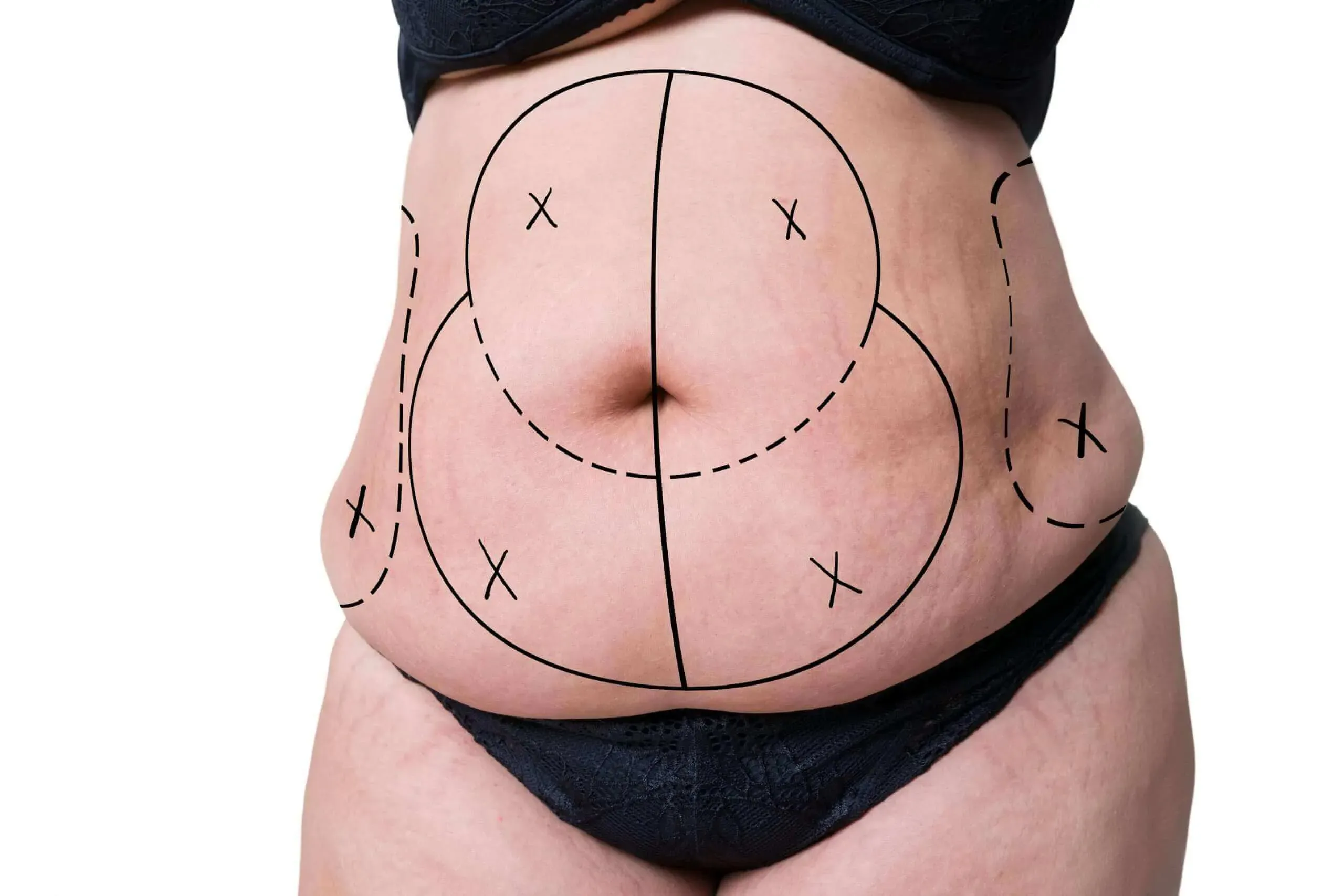 Abdominoplasty in Iran