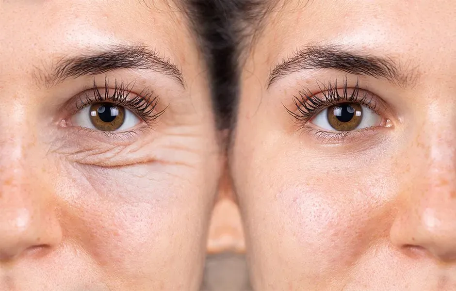 What is the difference between Canthoplasty & Blepharoplasty?