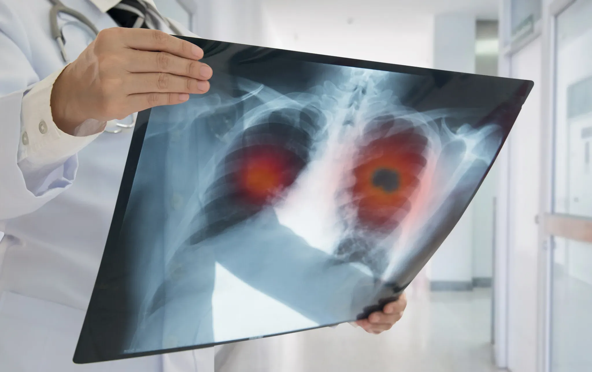 What are the different types of lung surgery?