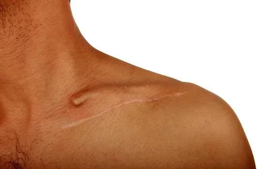 About Scar Removal