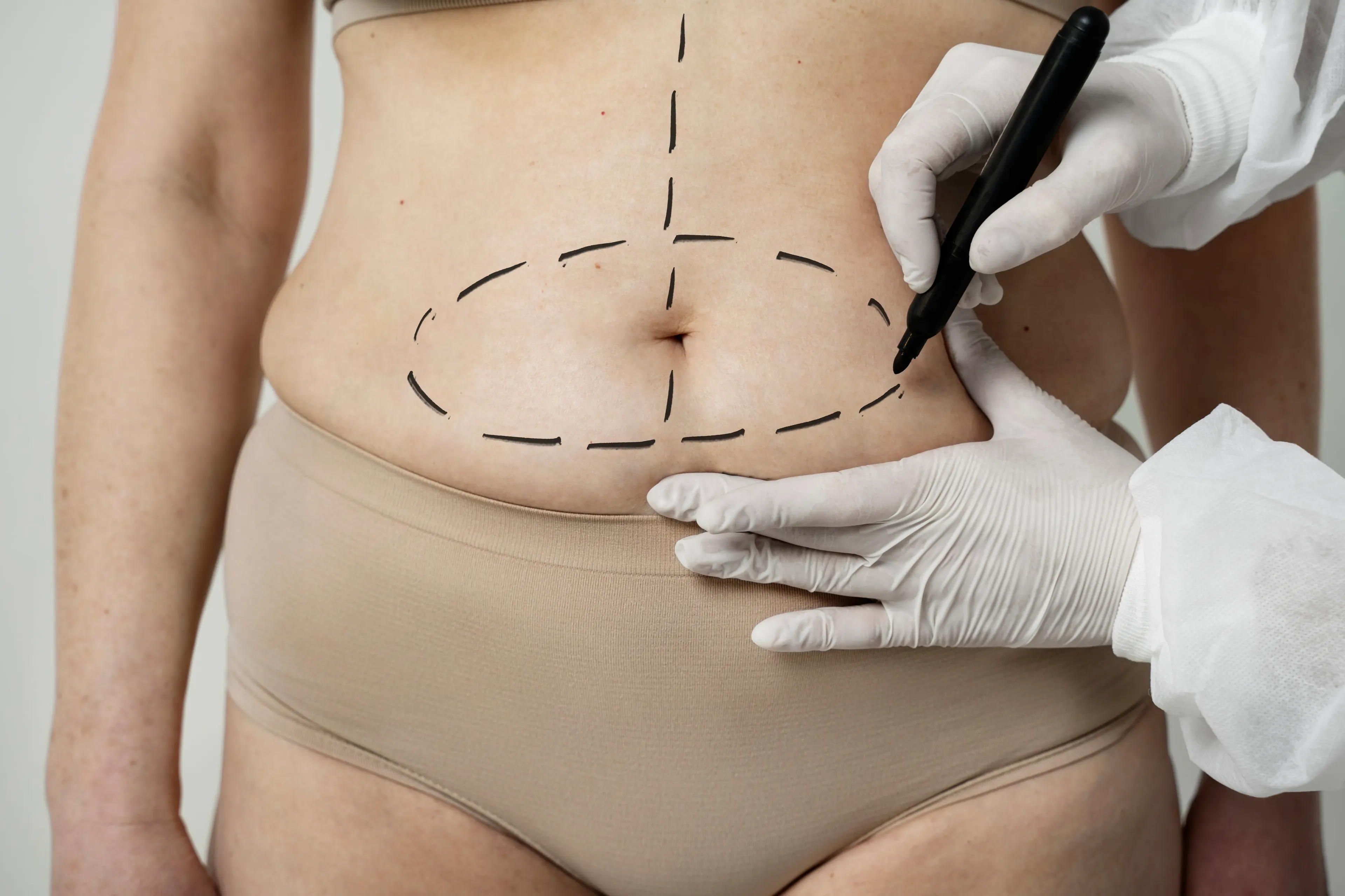 Abdominoplasty in Iran