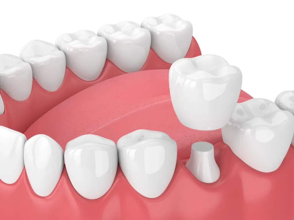 About Dental Crowns