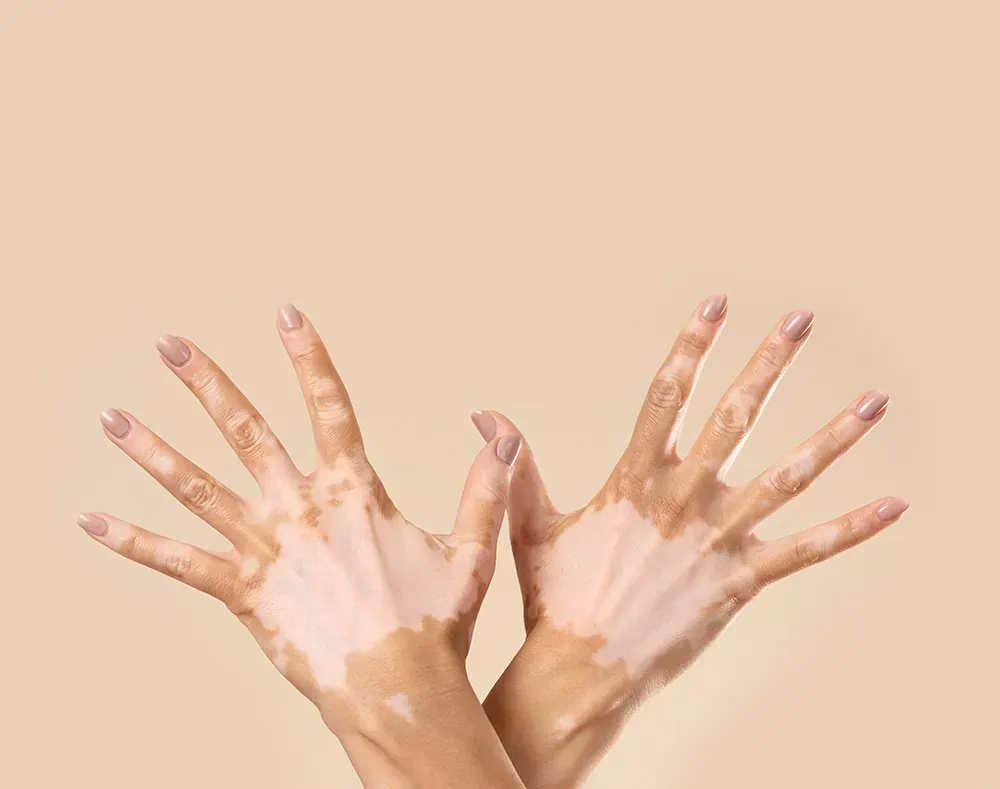 What is Vitiligo?