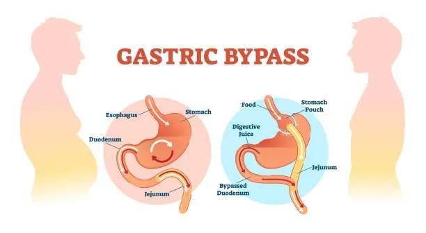 Gastric Bypass in Iran