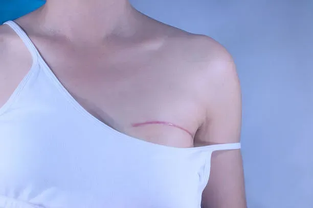 About Mastectomy