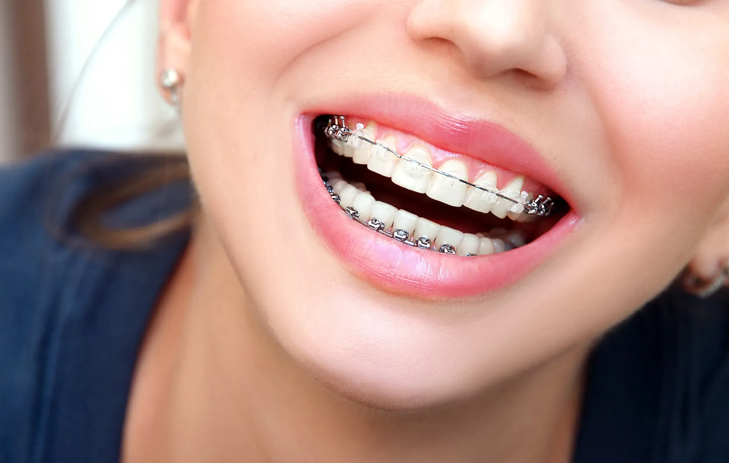 What is Orthodontics? 